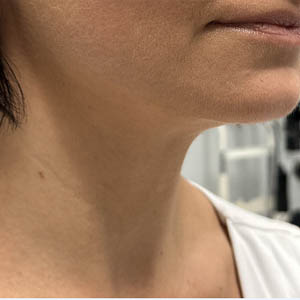 _0005_patient 7 after neck botox.PNG