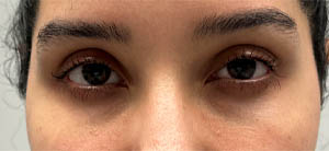 _0005_patient 7 after ptosis repair (front).PNG