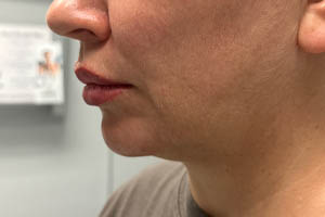 _0006_Patient 11 before chin and jawline (side).PNG
