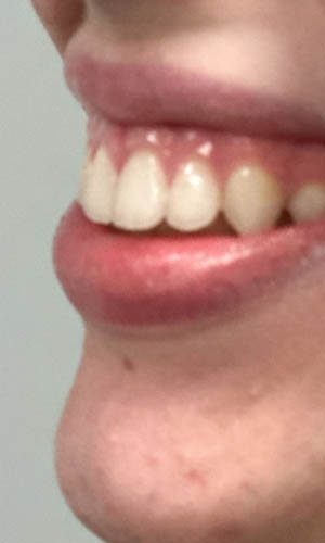 _0006_patient 3 before botox for gummy smile (side).PNG