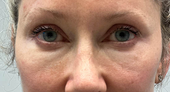 _0006_patient 3 before dissolving (front).PNG