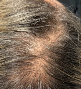 _0006_patient 3 before exosomes for hair.PNG