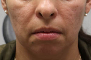 _0006_patient 5 before chin and jawline filler.PNG