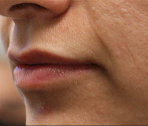 _0006_patient 7 before lip filler (side).PNG