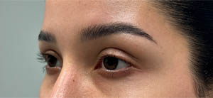 _0006_patient 7 before ptosis repair (side).PNG