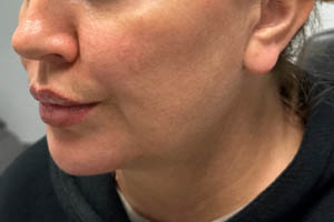 _0007_Patient 11 after chin and jawline (side).PNG