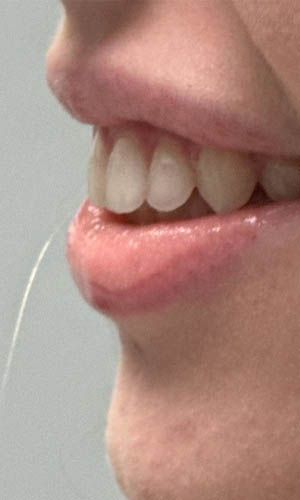 _0007_patient 3 after botox for gummy smile (side).PNG