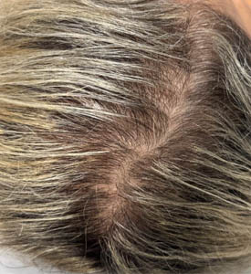_0007_patient 3 after exosomes for hair.PNG