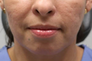 _0007_patient 5 after chin and jawline filler.PNG