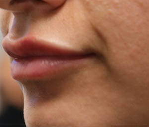 _0007_patient 7 after lip filler (side).PNG