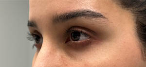 _0007_patient 7 after ptosis repair (side).PNG