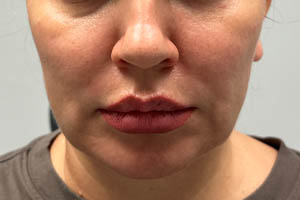 _0008_Patient 11 before chin and jawline.PNG