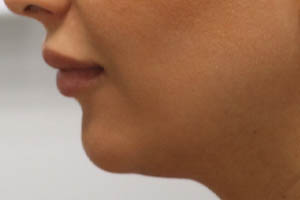 _0008_patient 6 before chin and jawline filler.PNG