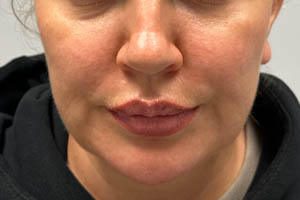 _0009_Patient 11 after chin and jawline.PNG