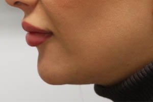 _0009_patient 6 after chin and jawline filler.PNG