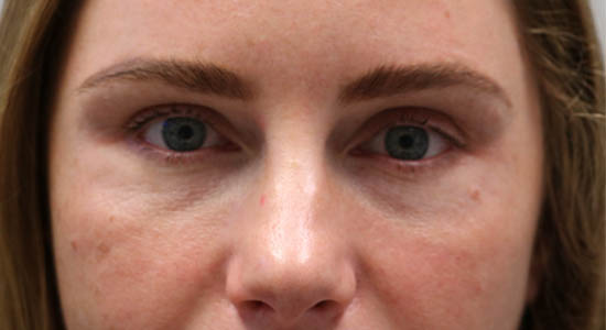_0010_patient 4 before dissolving.PNG