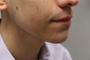 _0010_patient 7 before chin and jawline filler.PNG