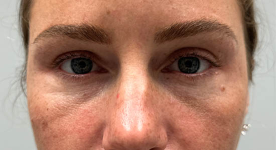 _0011_patient 4 after dissolving.PNG