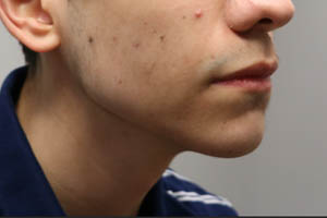 _0011_patient 7 after chin and jawline filler.PNG