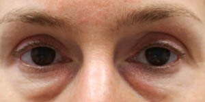 _0012_PT14- Front Before-Lower Bleph W fat grafting-.jpg