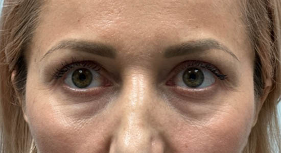 _0012_patient 5 before dissolving.PNG