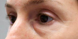 _0014_PT14-Before- Lower Bleph W fat grafting.jpg