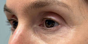 _0015_PT14-After- Lower Bleph W fat grafting.jpg