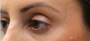 ptosis (1)