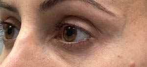 ptosis (2)