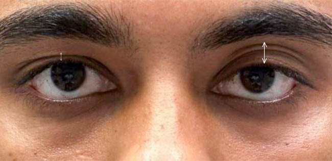 ptosis – 10