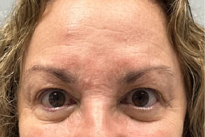 before and after surgery pictures | Top Miami Surgeon Gregory D. Lewen, MD