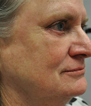 _0000_patient 2 after quad bleph with CO2.png