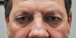 before and after surgery pictures | Top Miami Surgeon Gregory D. Lewen, MD