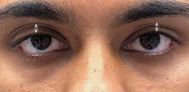 ptosis – 10