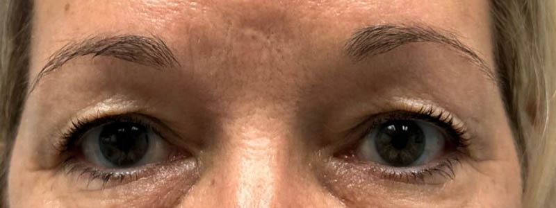 _0001_patient 14 before upper bleph with subbrow filler.JPG