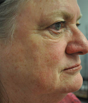 _0001_patient 2 before quad bleph with CO2.png
