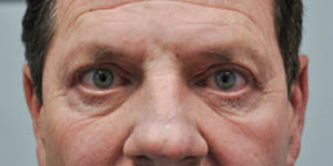before and after surgery pictures | Top Miami Surgeon Gregory D. Lewen, MD