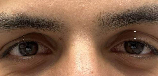 ptosis – 10