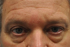 before and after surgery pictures | Top Miami Surgeon Gregory D. Lewen, MD