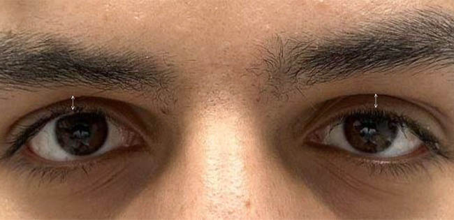 ptosis – 10