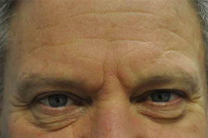 before and after surgery pictures | Top Miami Surgeon Gregory D. Lewen, MD