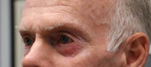 _0003_patient 3 after retraction repair side.PNG