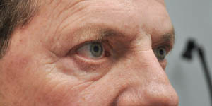 before and after surgery pictures | Top Miami Surgeon Gregory D. Lewen, MD