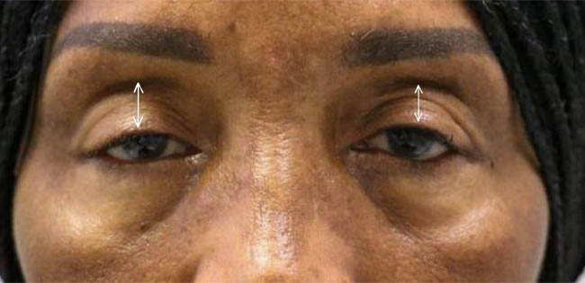 ptosis – 10