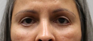 _0004_REVISION FOR LOWER EYELID RETRACTION WITH HARD PALATE GRAFT BEFORE PATIENT 2.PNG