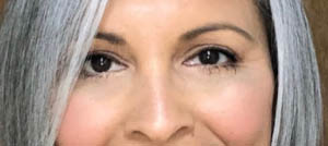 _0005_REVISION FOR LOWER EYELID RETRACTION WITH HARD PALATE GRAFT AFTER PATIENT 2.PNG