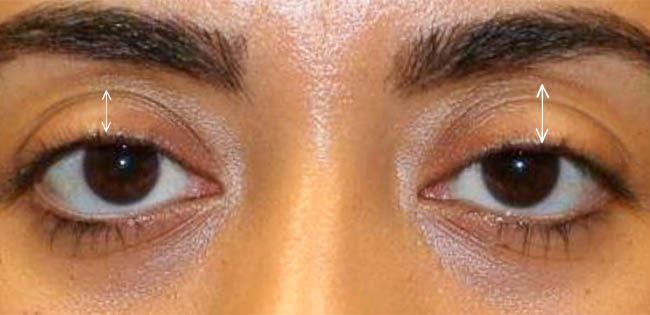 ptosis – 10