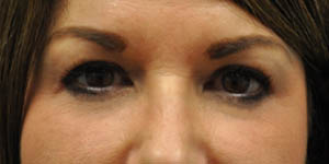 before and after surgery pictures | Top Miami Surgeon Gregory D. Lewen, MD