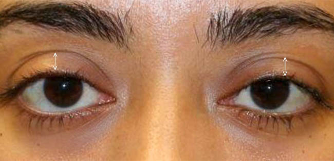 ptosis – 10