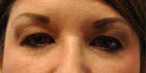 before and after surgery pictures | Top Miami Surgeon Gregory D. Lewen, MD